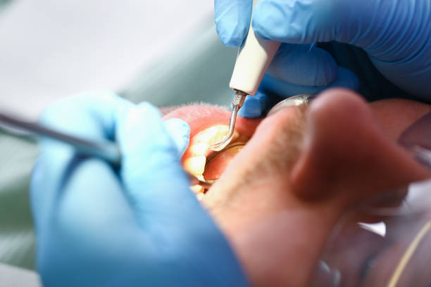 Best Emergency Root Canal Treatment in Hazardville, CT